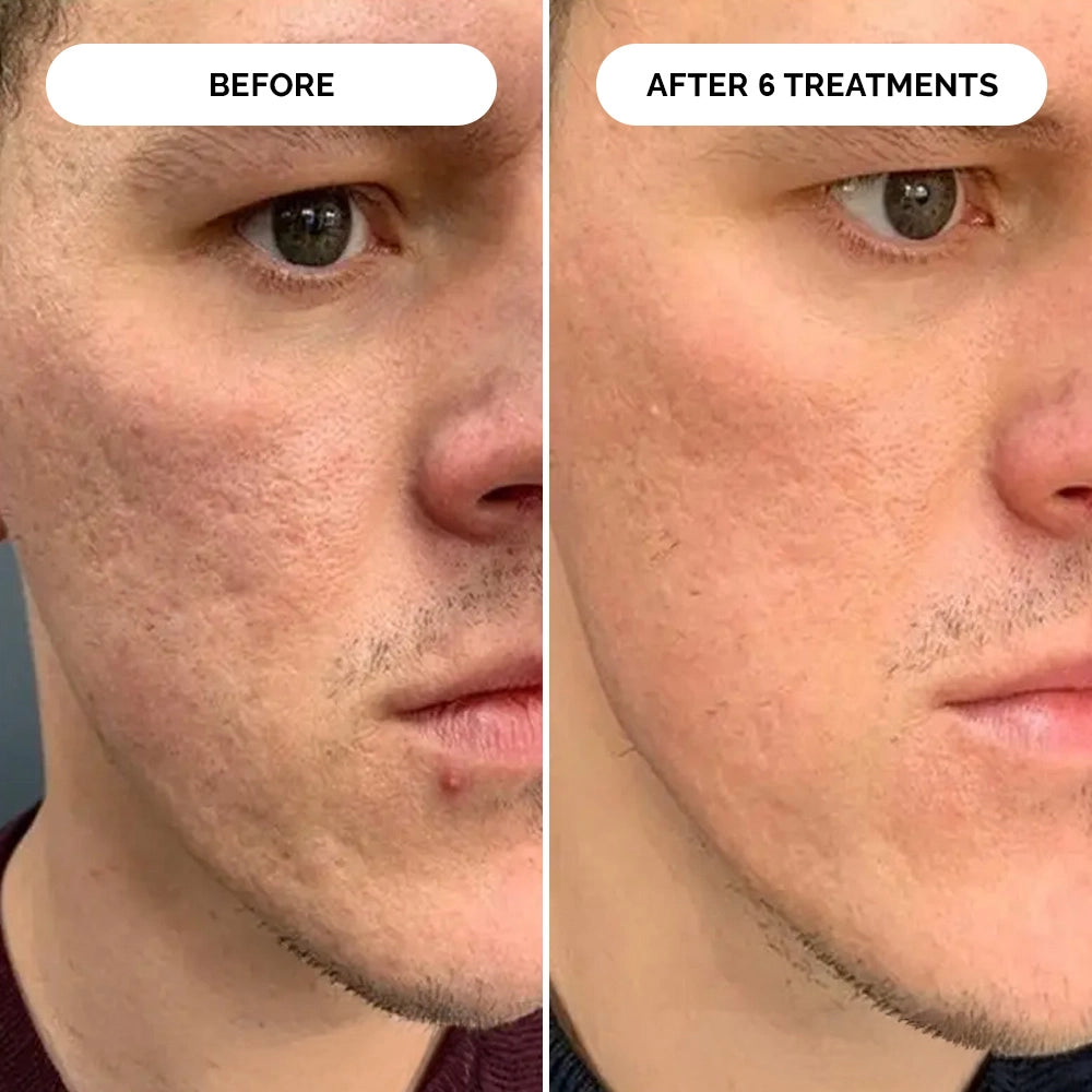 PDRN Micro-Infusion Skin Booster