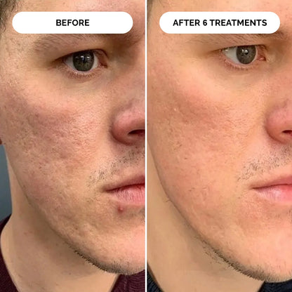 PDRN Micro-Infusion Skin Booster