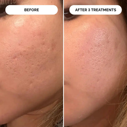 PDRN Micro-Infusion Skin Booster