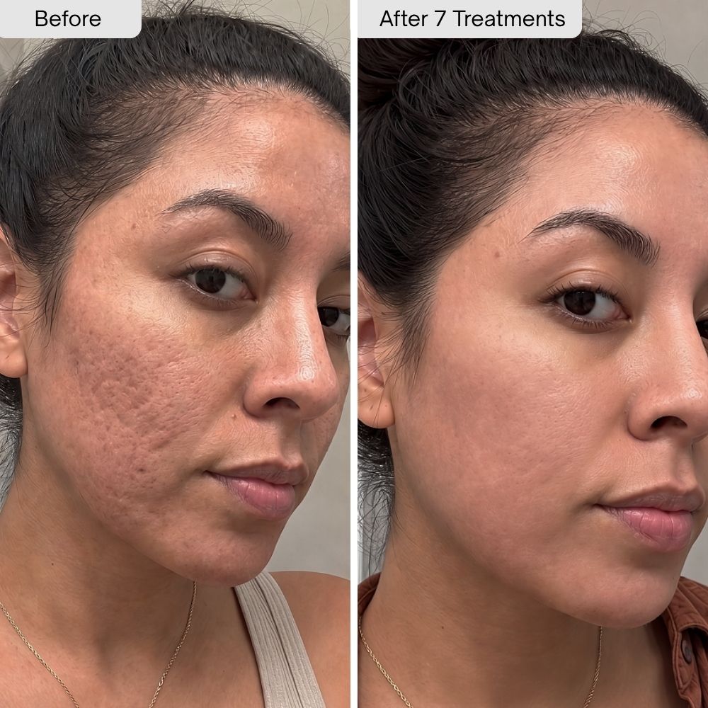 PDRN Micro-Infusion Skin Booster