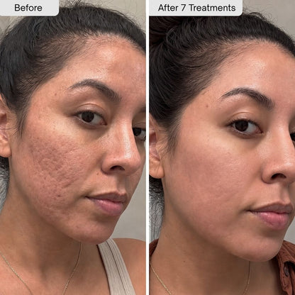 PDRN Micro-Infusion Skin Booster