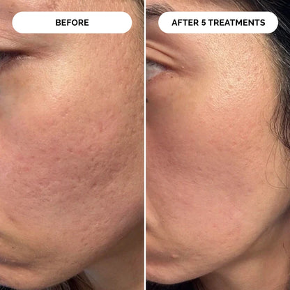 PDRN Micro-Infusion Skin Booster