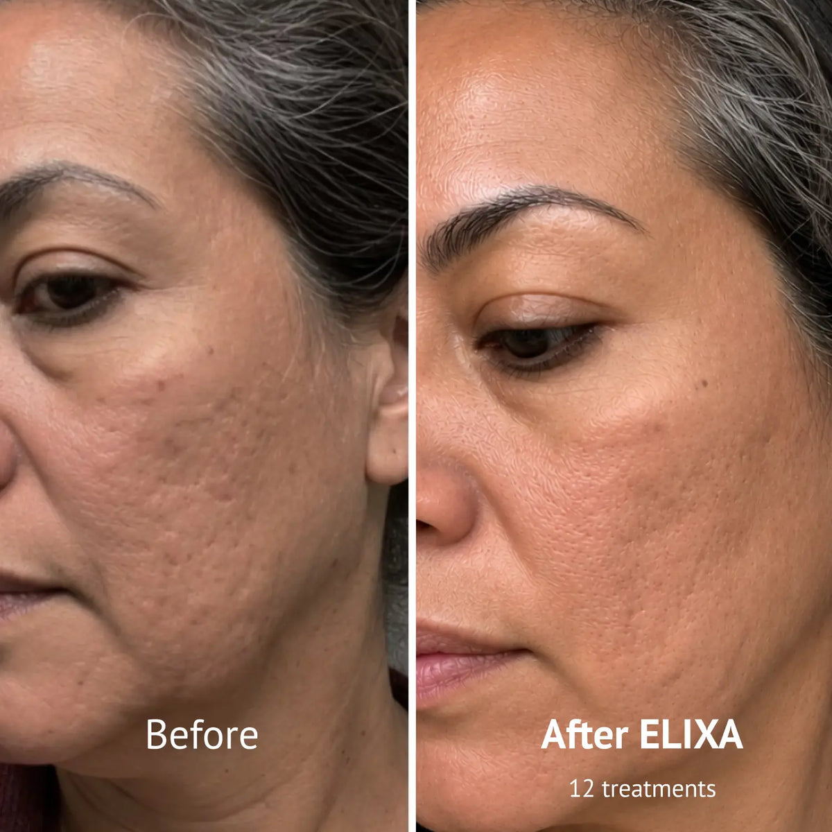 PDRN Micro-Infusion Skin Booster