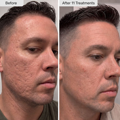 PDRN Micro-Infusion Skin Booster