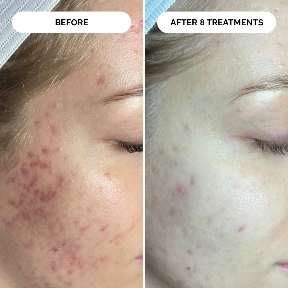 PDRN Micro-Infusion Skin Booster