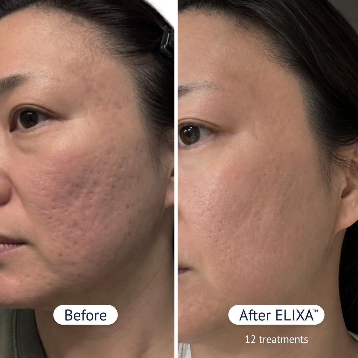 PDRN Micro-Infusion Skin Booster
