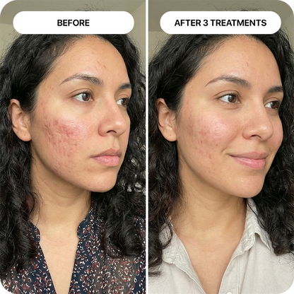 PDRN Micro-Infusion Skin Booster