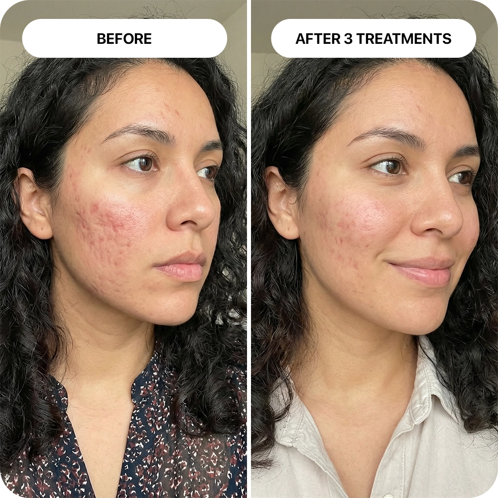 PDRN Micro-Infusion Skin Booster