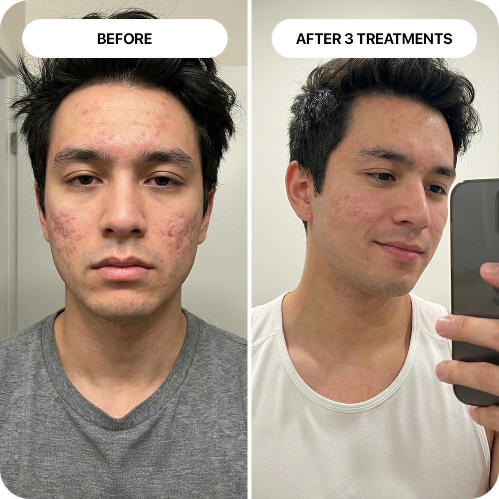 PDRN Micro-Infusion Skin Booster