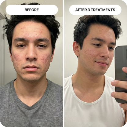 PDRN Micro-Infusion Skin Booster