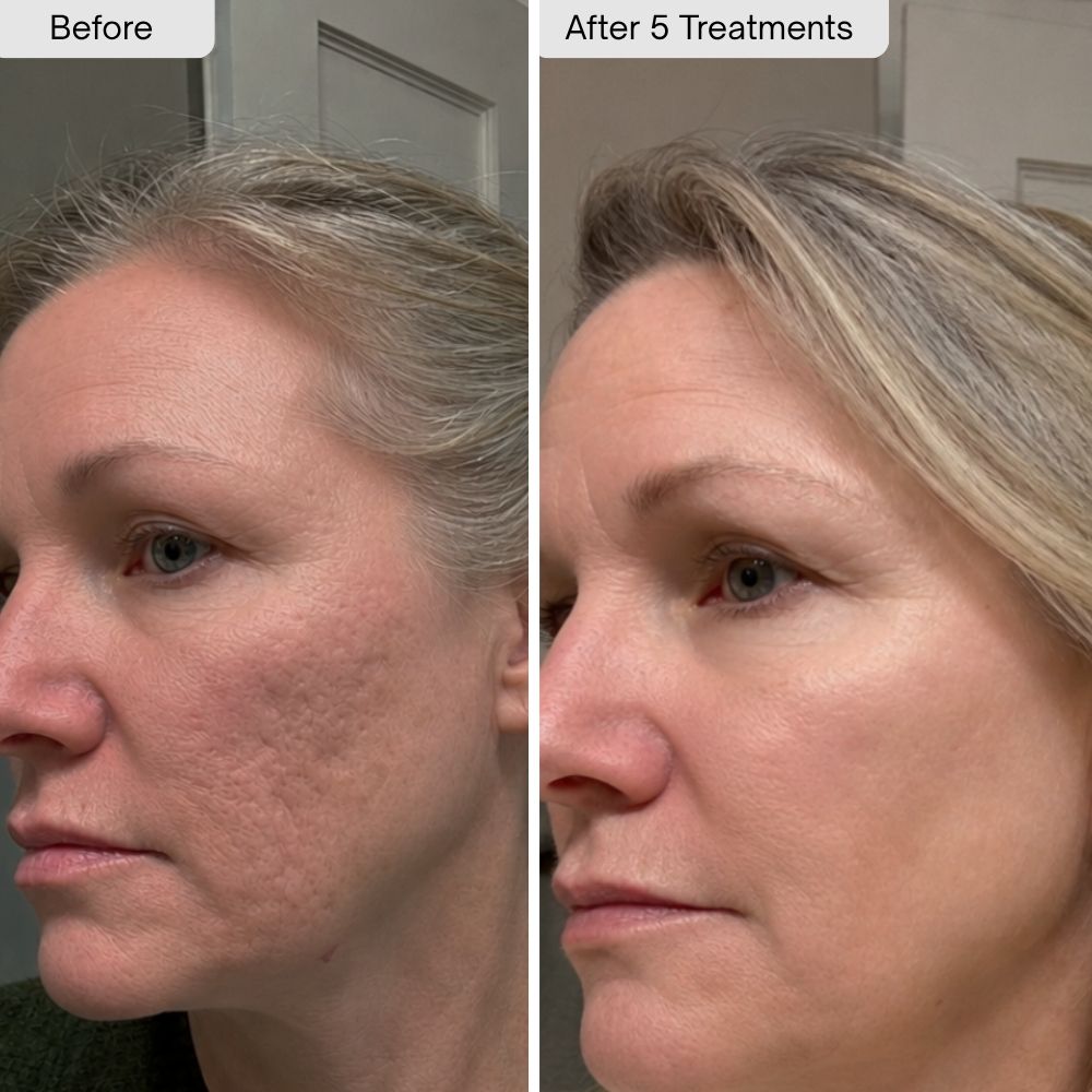 PDRN Micro-Infusion Skin Booster