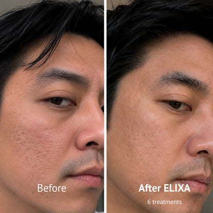 PDRN Micro-Infusion Skin Booster