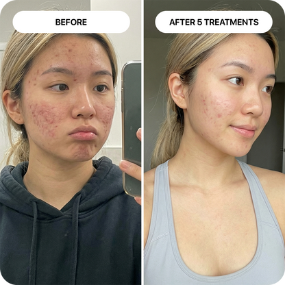 PDRN Micro-Infusion Skin Booster