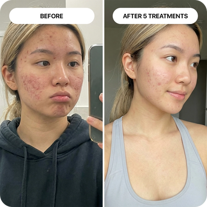 PDRN Micro-Infusion Skin Booster