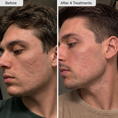 PDRN Micro-Infusion Skin Booster