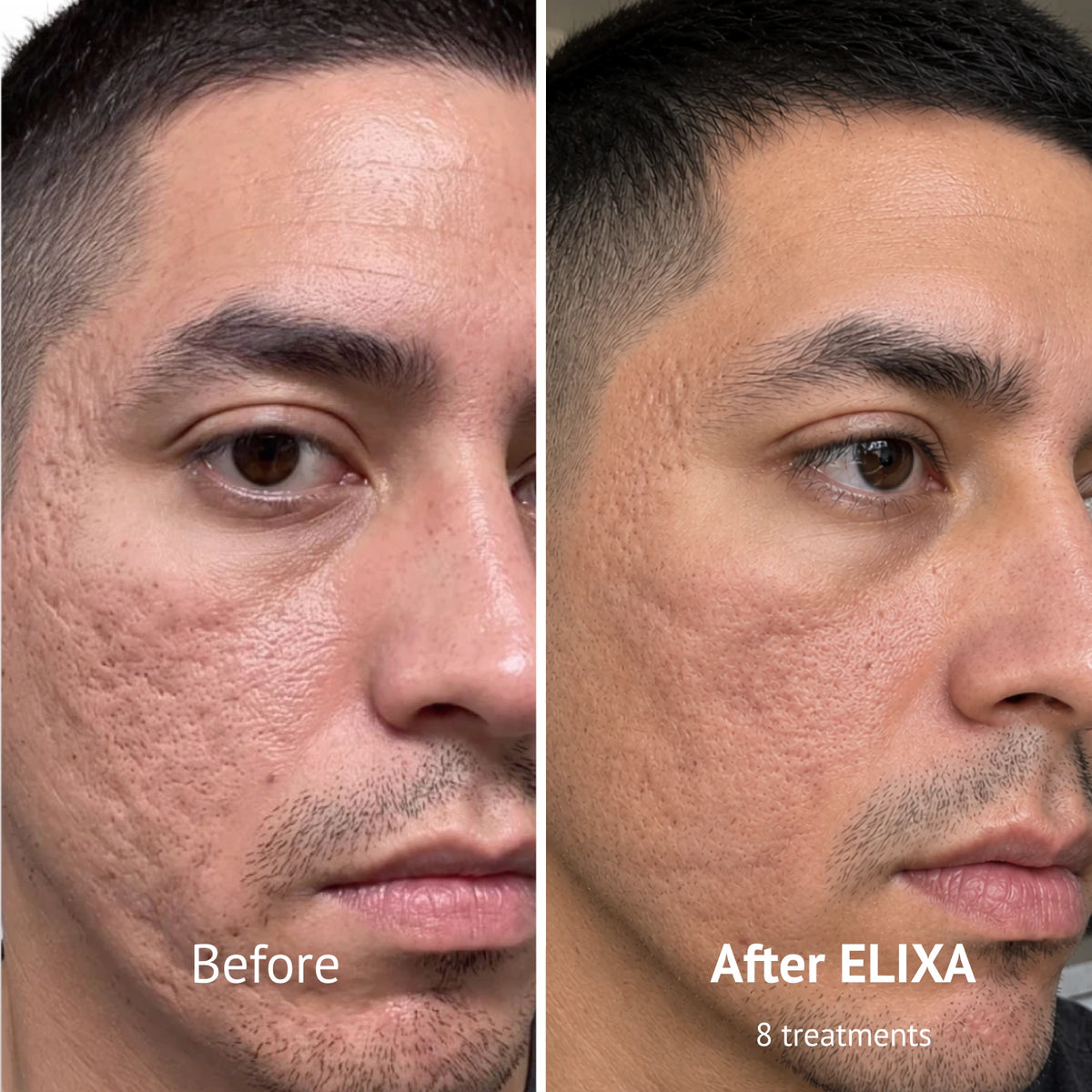 PDRN Micro-Infusion Skin Booster