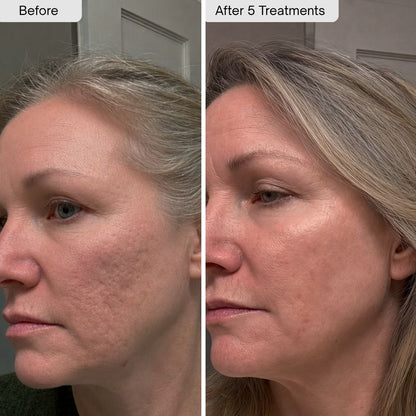 PDRN Micro-Infusion Skin Booster