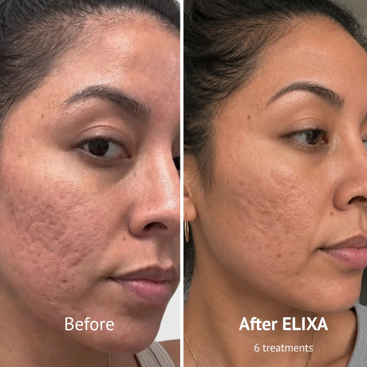 PDRN Micro-Infusion Skin Booster