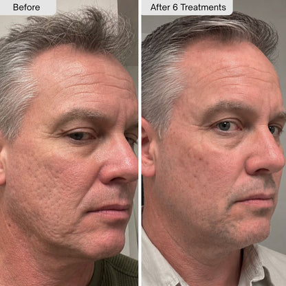 PDRN Micro-Infusion Skin Booster