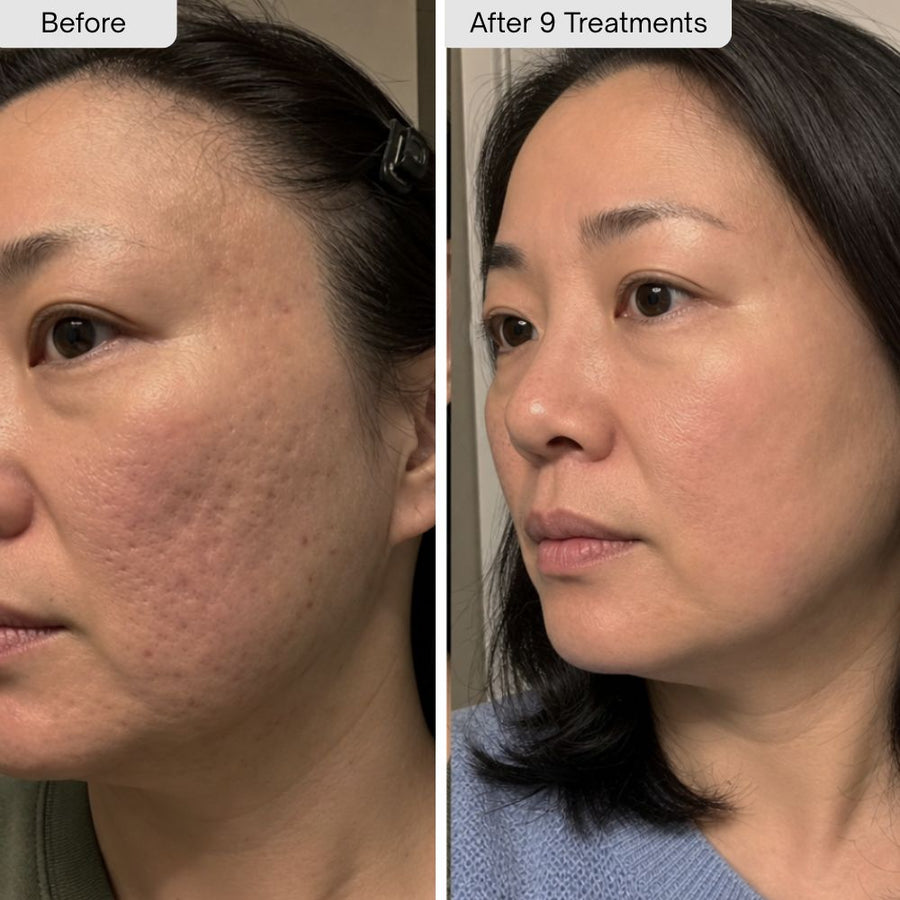 Ice Pick Scars and Red Marks customer transformation