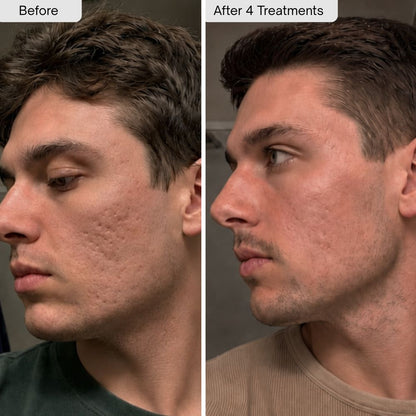 PDRN Micro-Infusion Skin Booster